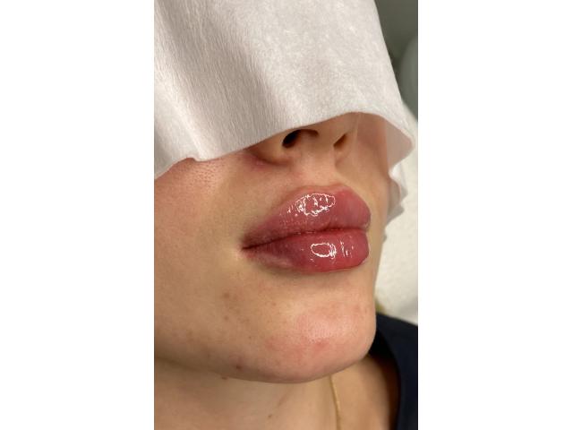 Гиалуроновая кислота для губ