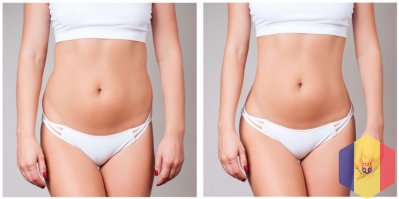 BodyTite: remodelare corporală fără bisturiu