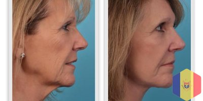 Face lift "Nefertiti" prin metoda 3D HIFU SMAS