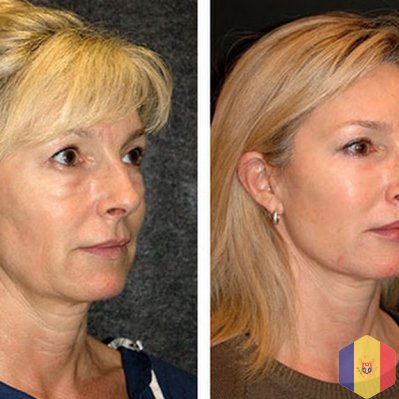 Подтяжка лица "Нефертити" методом 3D HIFU ультразвуковой SMAS-лифтинг!