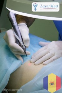 Condiloame genitale: îndepărtarea laser a verucilor genitali si condiloamelor  in Moldova ( Chisinau