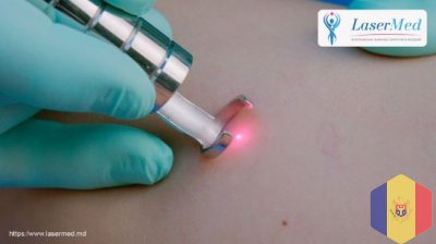 Tratamentul laser telangiectazii, capilare sparte, cuperoza