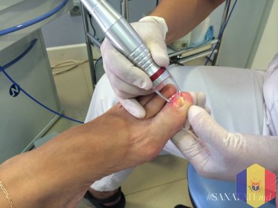 Tratament laser a onicomicozei in Moldova Tratament laser a onicomicozei (Infectia fungica a unghie